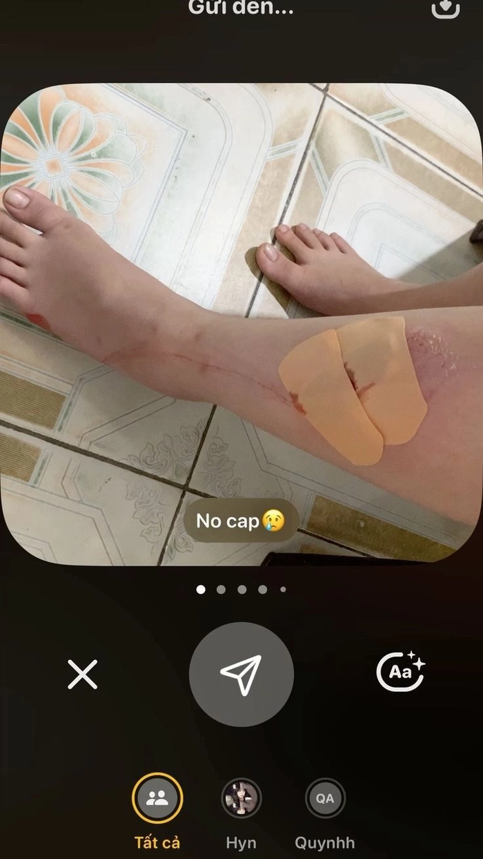 ảnh té xe chảy máu 