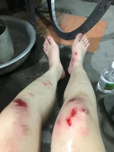 ảnh ngã xe xước gối