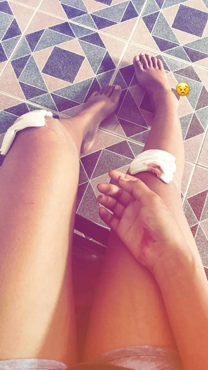 ảnh ngã xe xây xát 