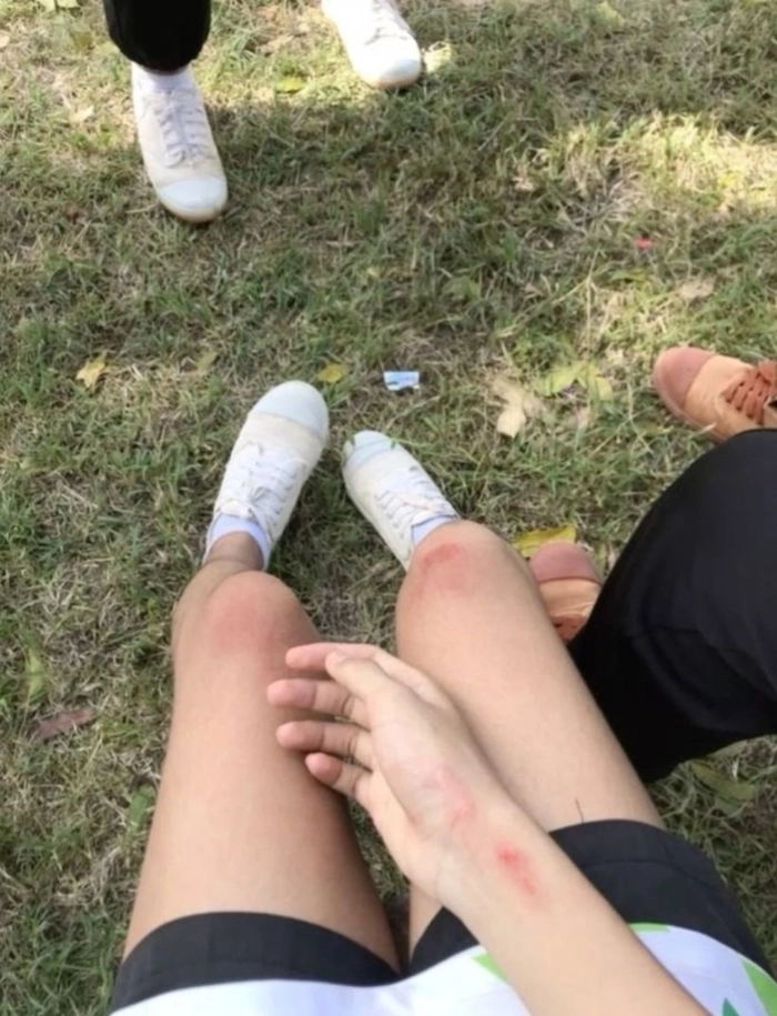 ảnh đầu gối trầy xước 