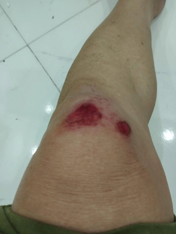 ảnh ngã xe máy 