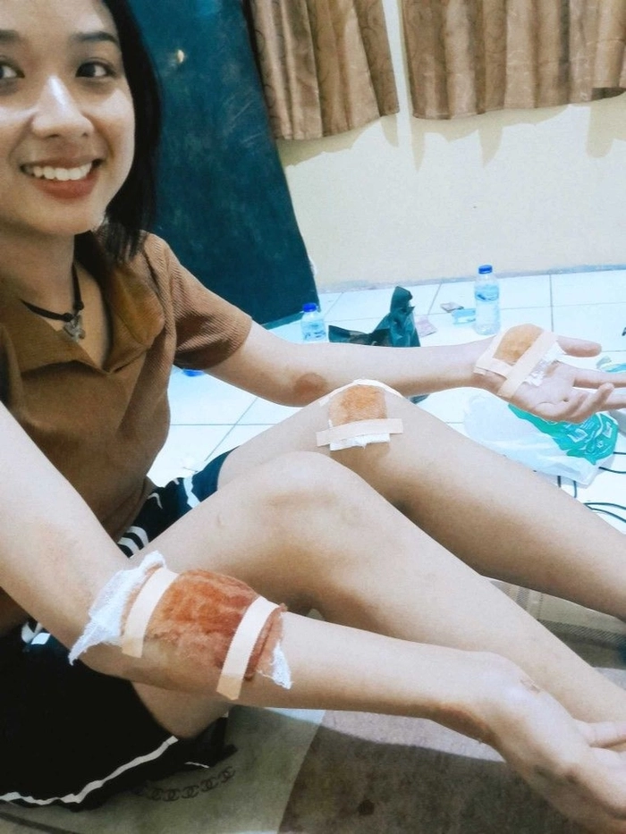 ảnh bị ngã vì trượt xe 