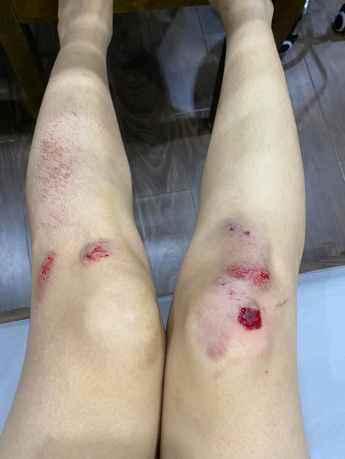 ảnh ngã xe xước tay 